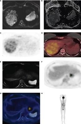 The expression of Ki-67 and Glypican -3 in hepatocellular carcinoma was evaluated by comparing DWI and 18F-FDG PET/CT